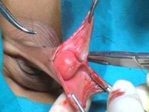 Surgical penis enlargement for men